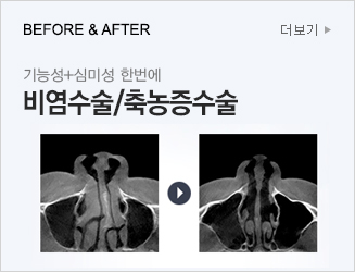 BEFORE & AFTER 기능성+심미성 한번에 비염수술/축농증수술 더보기