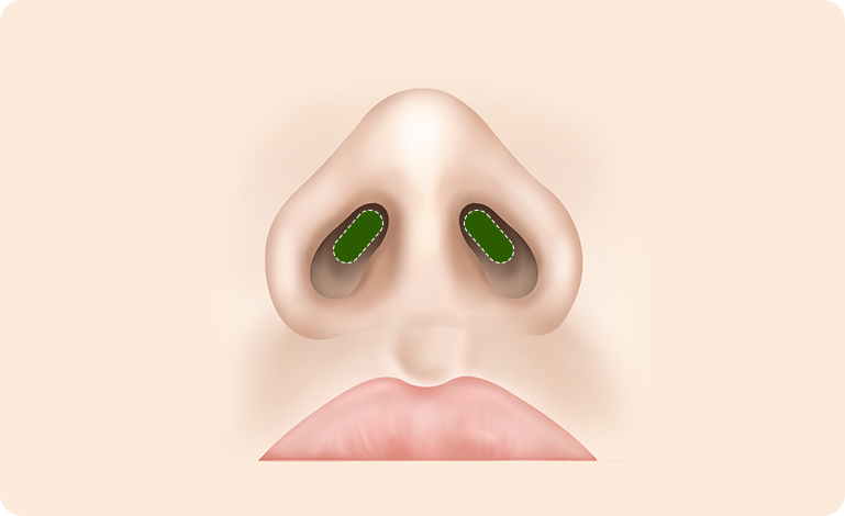 비밸브협착증이 동반된 경우