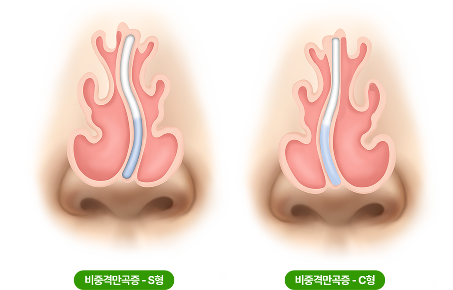 비중곡만곡증 - s형 / 비중곡만곡증 - c형